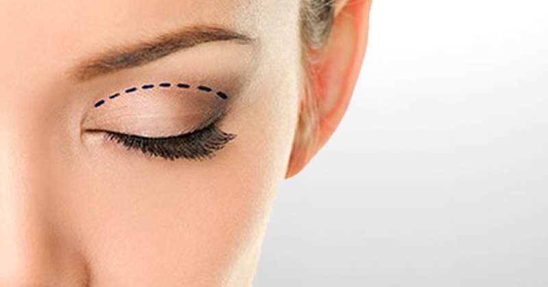 كيف يتم تصحيح الجفون المترهلة بواسطة تجميل الجفون؟