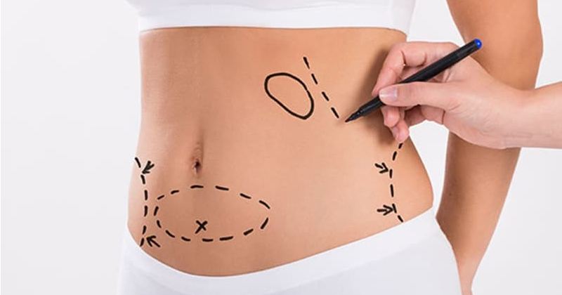Liposuction Guide: The Most Effective Way to Get Rid of Regional Fat