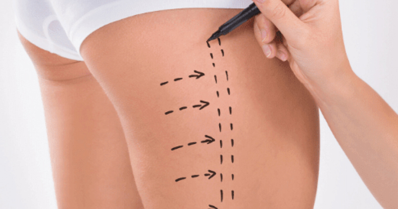 عملية شد الفخذين: كل ما تحتاجين إلى معرفته — هل هي مناسبة لك؟