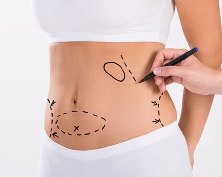 Liposuction (Yağ Alma) Hakkında Merak Edilenler
