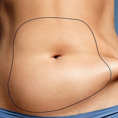 Liposuction