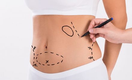 Liposuction (Yağ Alma) Hakkında Merak Edilenler
