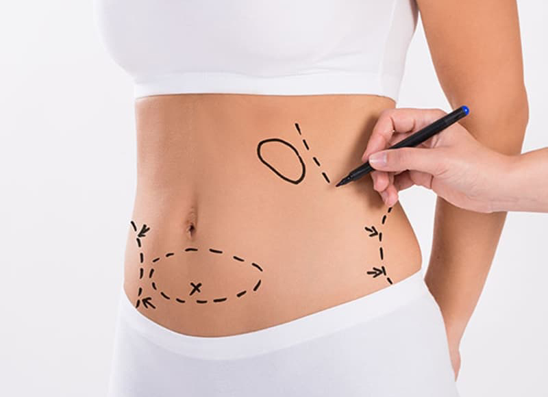 liposuction-hakkinda-merak-edilenler